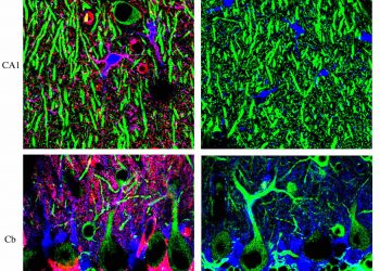 Разработан новый тест, который отличает демиелинизирующие заболевания от РС 5 Разработан новый тест, который отличает демиелинизирующие заболевания от РС