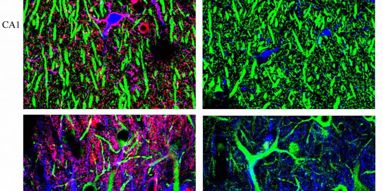Разработан новый тест, который отличает демиелинизирующие заболевания от РС