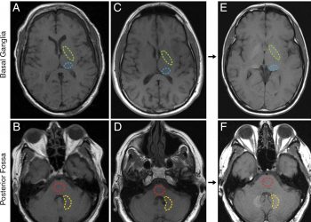 Гадолиниевый контраст опасен при рассеянном склерозе 5 Гадолиниевый контраст опасен при рассеянном склерозе
