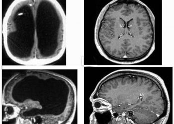 Мужчина, который живёт без 90% мозга, озадачил учёных
