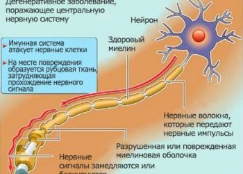 Обзор демиелинизирующих расстройств 5 Обзор демиелинизирующих расстройств