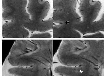 МРТ 7 тесла отслеживает прогрессирование рассеянного склероза
