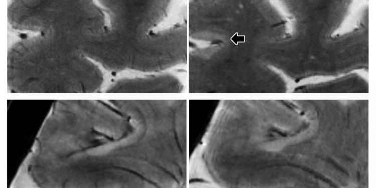МРТ 7 тесла отслеживает прогрессирование рассеянного склероза