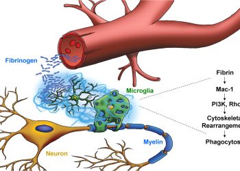 Роль фибриногена при рассеяном склерозе