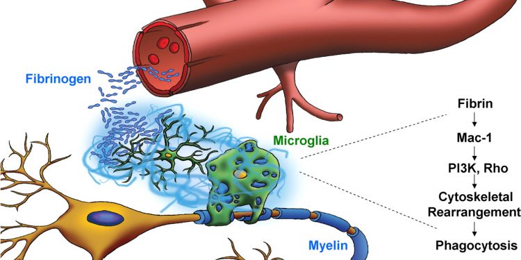 Роль фибриногена при рассеяном склерозе 1 Роль фибриногена при рассеяном склерозе