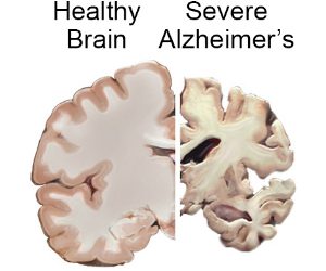 Факты о болезни Альцгеймера