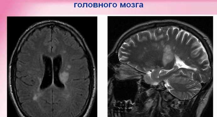 Что такое демиелинизирующие заболевания?