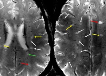 МРТ 7 тесла новое видение микрососудистых нарушений при рассеянном склерозе