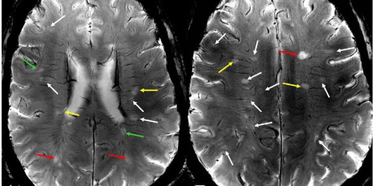 МРТ 7 тесла новое видение микрососудистых нарушений при рассеянном склерозе 1 МРТ 7 тесла новое видение микрососудистых нарушений при рассеянном склерозе