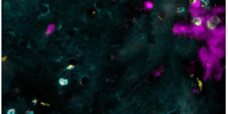 Связан ли рассеянный склероз с детскими вирусными инфекциями? 1 Связан ли рассеянный склероз с детскими вирусными инфекциями?