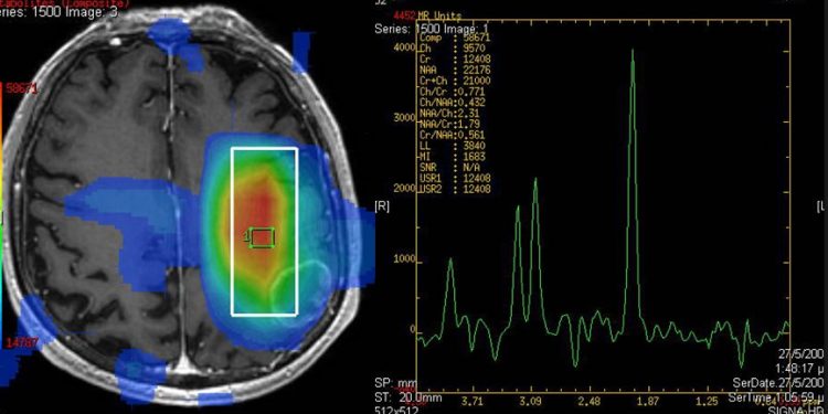 Рассеянный склероз это метаболически зависимое, нейродегенеративное заболевание. 1 Рассеянный склероз это метаболически зависимое, нейродегенеративное заболевание.