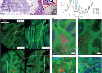 Воспаление увеличивает задержку гадолиния в мозге после введения линейного контрастного вещества на основе гадолиния