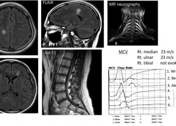 Анти-нейрофаскиновое аутоантитела и демиелинизация
