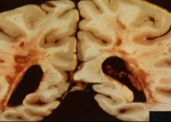 Роль гематоэнцефалического барьера в неврологических заболеваниях