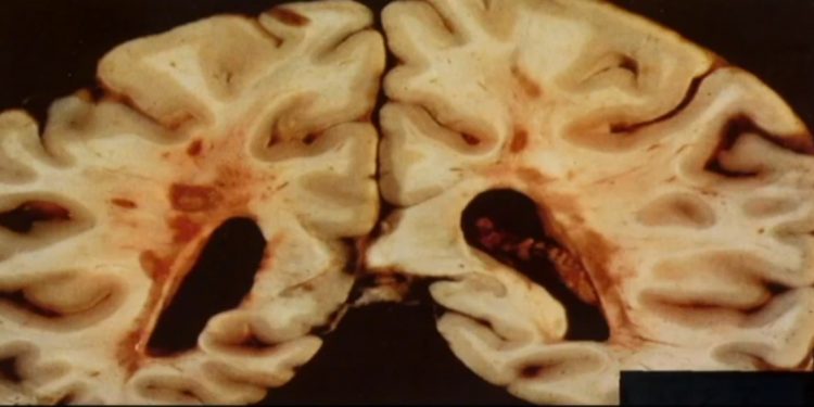 Роль гематоэнцефалического барьера в неврологических заболеваниях