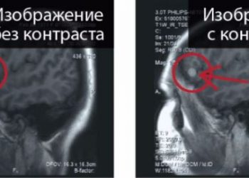 Вред контраста мрт, гадолиний откладывается в мозге при раннем рассеянном склерозе.
