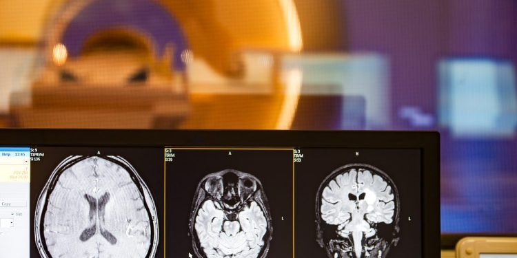 Центральное венозное пятно сохраняет потенциал как диагностический маркер РС