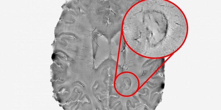 Скорость прогрессирования рассеянного склероза зависит от вялотекущего воспаления в мозге