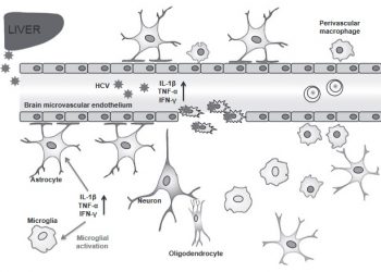 Вирус гепатита С в мозге вызывал астроглиоз и демиелинизацию
