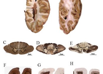 Миелокортикальный рассеянный склероз: нейродегенерация без демиелинизации белого вещества