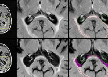 Исследователи UB обнаруживают подсказки, которые могут помоч диагностировать диагноз РС по МРТ