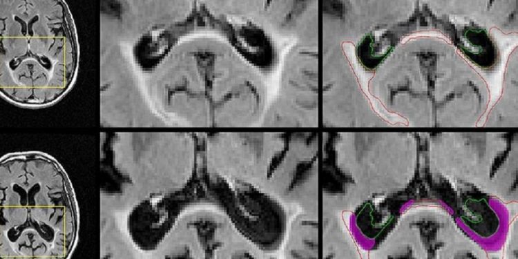 Исследователи UB обнаруживают подсказки, которые могут помоч диагностировать диагноз РС по МРТ