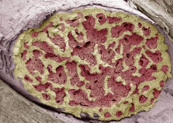 Исследование трансплантации костного мозга может заменить гиперактивные иммунные клетки, предотвращая воспаление при РС