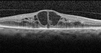 Увеит и отек сетчатки при рассеянном склерозе
