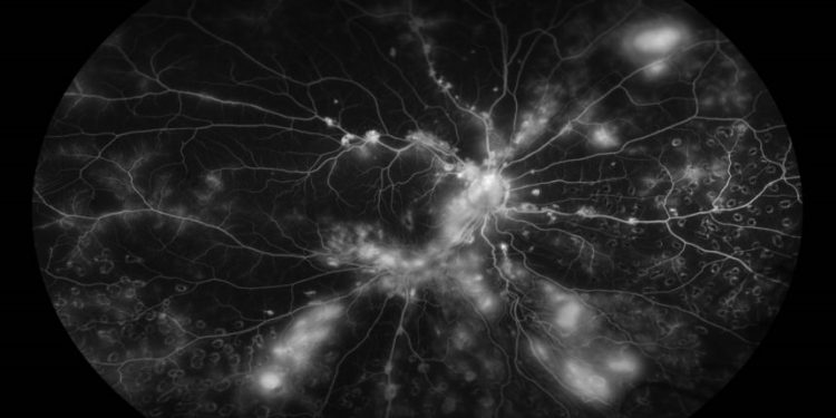 Алемтузумаб Лечение рассеянного склероза может вызвать опасный для жизни ANCA-ассоциированный васкулит 1 Алемтузумаб Лечение рассеянного склероза может вызвать опасный для жизни ANCA-ассоциированный васкулит