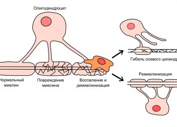 Высокий генетический риск рассеянного склероза (РС) связан со структурными изменениями в белом веществе в мозге детей