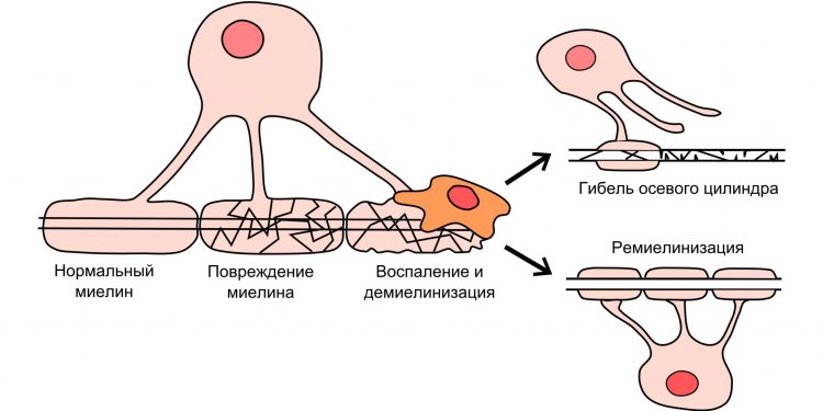 Высокий генетический риск рассеянного склероза (РС) связан со структурными изменениями в белом веществе в мозге детей