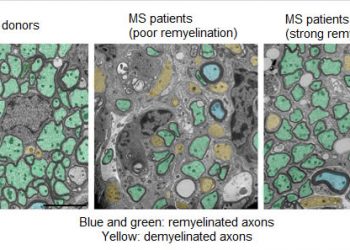 Рассеянный склероз регенерация и ремиелинизация