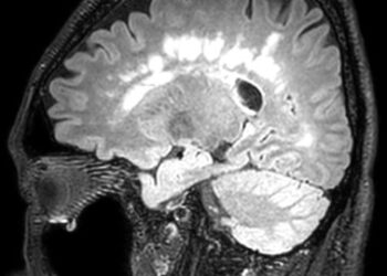 CADASIL, имитирующий рассеянный склероз как ошибочный диагноз