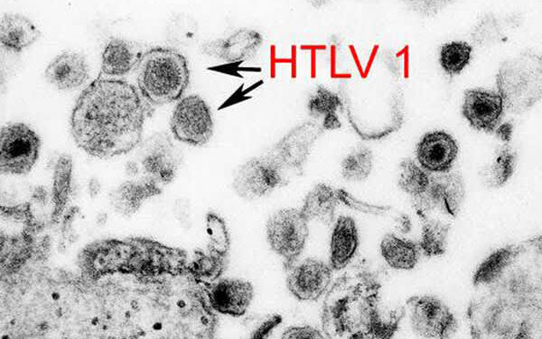 Нейроиммунология миелопатии, ассоциированной с человеческим Т-лимфотропным вирусом типа 1 / тропического спастического парапареза 1 Нейроиммунология миелопатии, ассоциированной с человеческим Т-лимфотропным вирусом типа 1 / тропического спастического парапареза