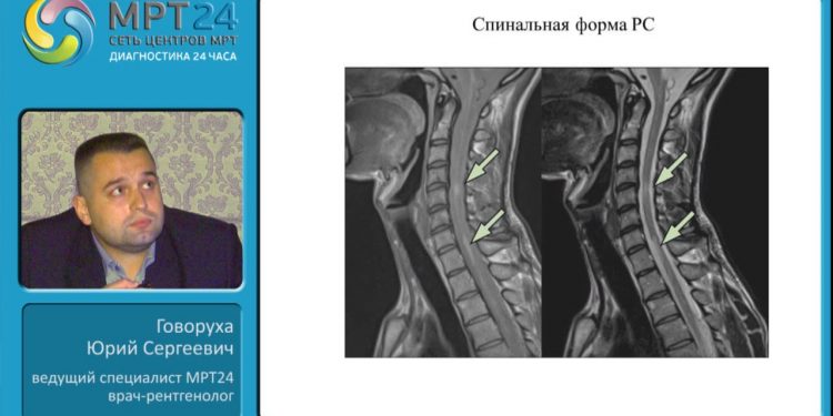 Демиелинизирующие заболевания на МРТ вебинар