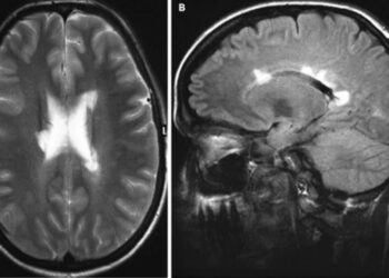 Рассеянный склероз? нет адренолейкодистрофия!