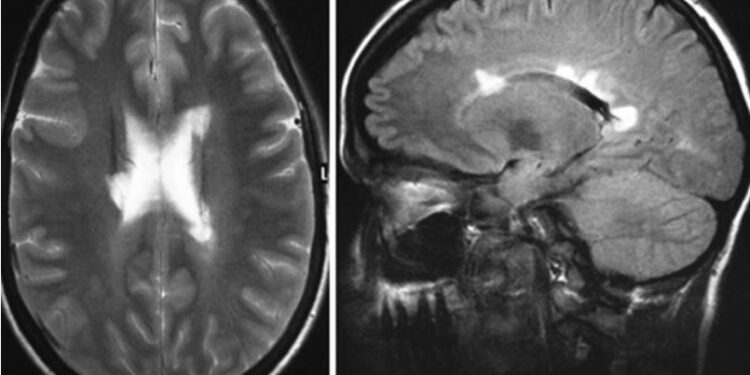 Рассеянный склероз? нет адренолейкодистрофия!