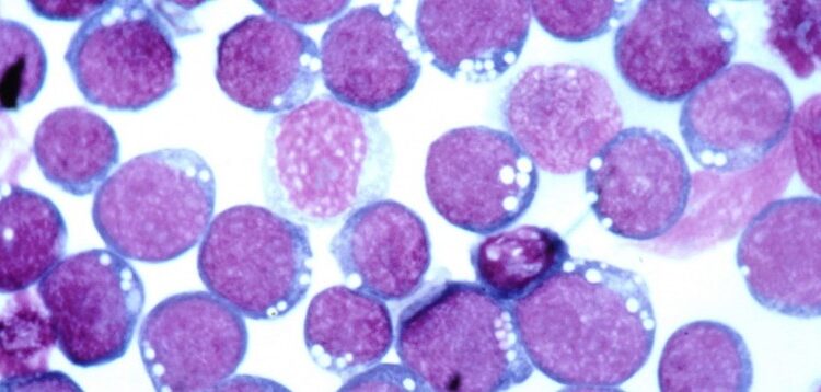 Как вирус Эпштейна-Барра может повлиять на рассеянный склероз?