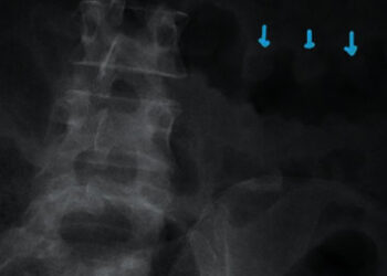 Тяжелый колит, индуцированный окрелизумабом