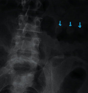 Тяжелый колит, индуцированный окрелизумабом 1 Тяжелый колит, индуцированный окрелизумабом