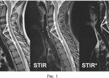Бессимптомные поражения спинного мозга при рассеянном склерозе