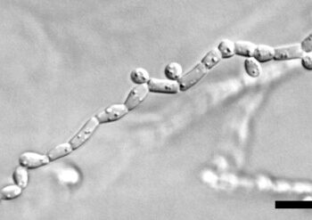 Обнаружены грибковые инфекции в мозге пациентов с рассеянным склерозом