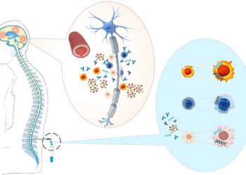 Олигоклональные полосы — насколько достоверны при РС?