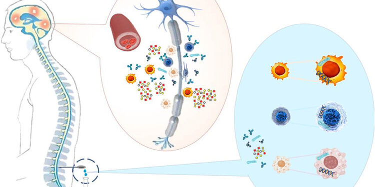 Олигоклональные полосы — насколько достоверны при РС?