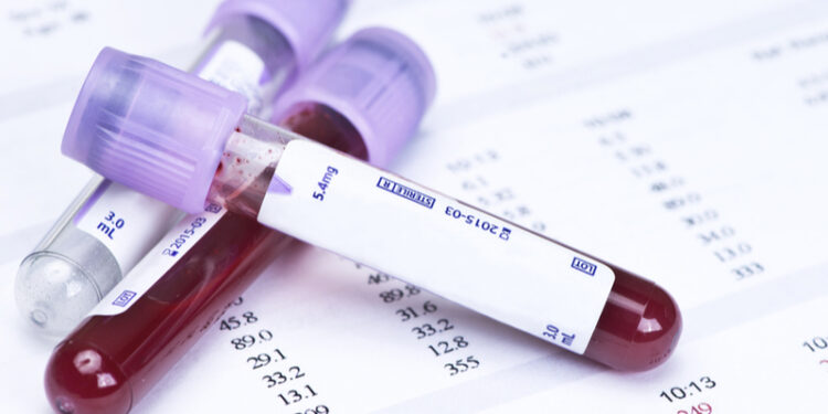 Индекс легкой цепи FLC предсказывает раннюю активность рассеянного склероза 1 Индекс легкой цепи FLC предсказывает раннюю активность рассеянного склероза