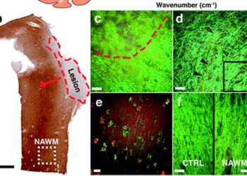 Биохимические изменения липидов, обнаруженные в нормальном внешнем белом веществе хронического рассеянного склероза с помощью спектральной когерентной рамановской визуализации