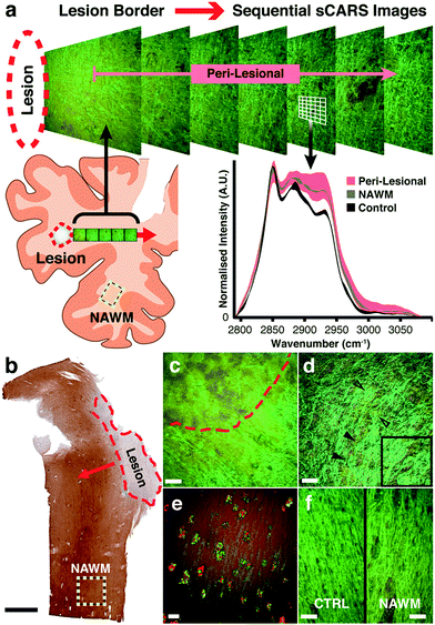 Биохимические изменения липидов, обнаруженные в нормальном внешнем белом веществе хронического рассеянного склероза с помощью спектральной когерентной рамановской визуализации
