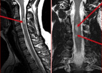 ACTRIMS 2023: потеря миелина в спинном мозге связана с большей инвалидностью по рассеянному склерозу