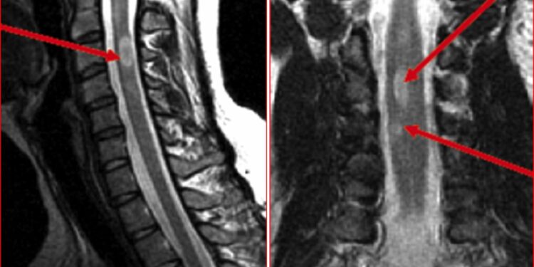 ACTRIMS 2023: потеря миелина в спинном мозге связана с большей инвалидностью по рассеянному склерозу 1 ACTRIMS 2023: потеря миелина в спинном мозге связана с большей инвалидностью по рассеянному склерозу